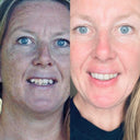 Straighter teeth in 4-6 months - Shortest time to straighten teeth | NewSmile