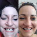 Natalie: Before and after using NewSmile aligners to close front teeth gap