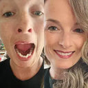 Teeth crowding case fixed with NewSmile aligners: Customer smile before and after treatment