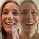 Smile transformation: moderate crowding to straight teeth with NewSmile
