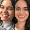Before and after: NewSmile aligners fixing crowded teeth