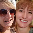 Visible gap closed with NewSmile's clear aligner treatment: Before and after photos