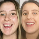 Before and after comparison of a woman with teeth crowding