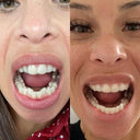 Vanessa – Before and After NewSmile® Clear Aligner Treatment for Lower Arch Crowding