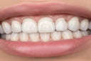 Can Night Guards Help Protect Veneers?