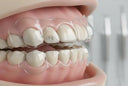 Can Night Guards Help with Dental Bridges?