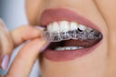 Clear aligners worn at night as a discreet teeth straightening solution