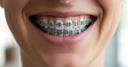 Cost Check: How Much Are Braces for Adults?