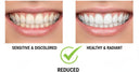 Before and after results using gentle brushing, toothpaste tablets, and whitening system