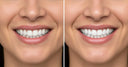 Smile transformation using porcelain veneers