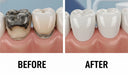 What is Crown? A Deep Dive into Dental Crowns