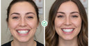 Smile results preserved with clear orthodontic retainers
