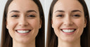Patient showing results after nighttime aligner treatment