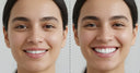 Comparison of teeth before and after using toothpaste tablets for whitening
