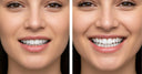 Comparison of smile before and after veneers