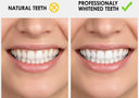 Teeth whitening before and after comparison