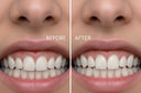 Is Quick Invisalign Worth It for Small Fixes?