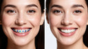 before and after split image showing a smile after Invisalign and after veneers.