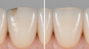 Dental bonding before and after repairing a chipped tooth