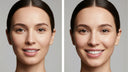 Cheek Dimples from Retainers? The Truth