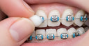 Braces rubbing against lips causing mouth sores