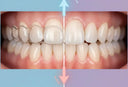 Teeth alignment with and without retainer use