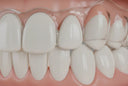 Clear Invisalign-style aligner fitted on teeth