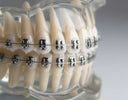Close-up view of lingual braces attached to the back surfaces of teeth on a dental model.