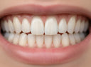Straight, whitened teeth after Invisalign and professional whitening