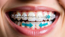 Close-up of teeth with clear aligners and improvement arrows
