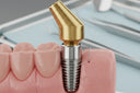 How Long Does a Tooth Implant Take: A Comprehensive Guide