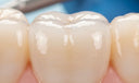 Dental sealants on adult molar teeth