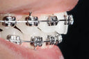 Close-up of traditional metal braces used for overbite correction