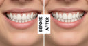 Before and after results using affordable teeth aligners