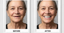 Before-and-after smile transformation with immediate dentures