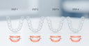 From Consultation to Completion: Your Journey with NewSmile Aligners