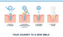 How-Long-Do-Dental-Implants-Take NewSmile™ USA