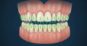 Aligners and the Prevention of Tooth Wear: Protecting Your Enamel