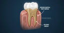Aligners and Gum Recession: Prevention and Treatment Options