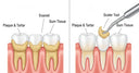 Illustration of tooth scaling removing tartar buildup from teeth surfaces
