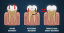 Illustration of different tooth movements with aligners