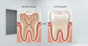 Unlocking the Benefits: Dental Sealants for Adults