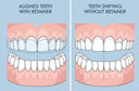 How retainers prevent orthodontic relapse