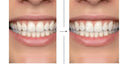 Cheapest Way to Fix Crooked Front Teeth