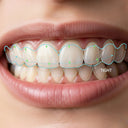 Why-Your-Retainer-Feels-Tight-And-Is-It-Normal NewSmile™ USA