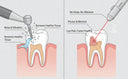 Comparison of dental laser versus traditional drill
