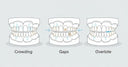 Can Clear Aligners Correct Crooked Teeth
