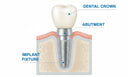 How Long Does Dental Implant Take: A Comprehensive Guide