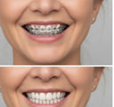 Braces before veneers smile transformation