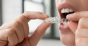 Vivera retainer being worn after Invisalign treatment